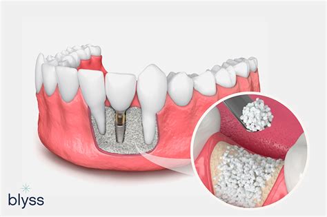 bone graft the villages fl|Dentist The Villages Smiles .